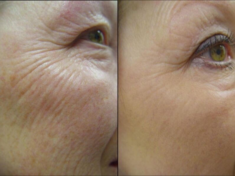 Sateuacan jeung sanggeus laser rejuvenation prosedur - a réduksi signifikan dina wrinkles