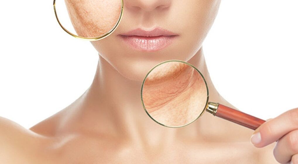 Wrinkles bisa éféktif ngaleungitkeun kalawan perlakuan laser